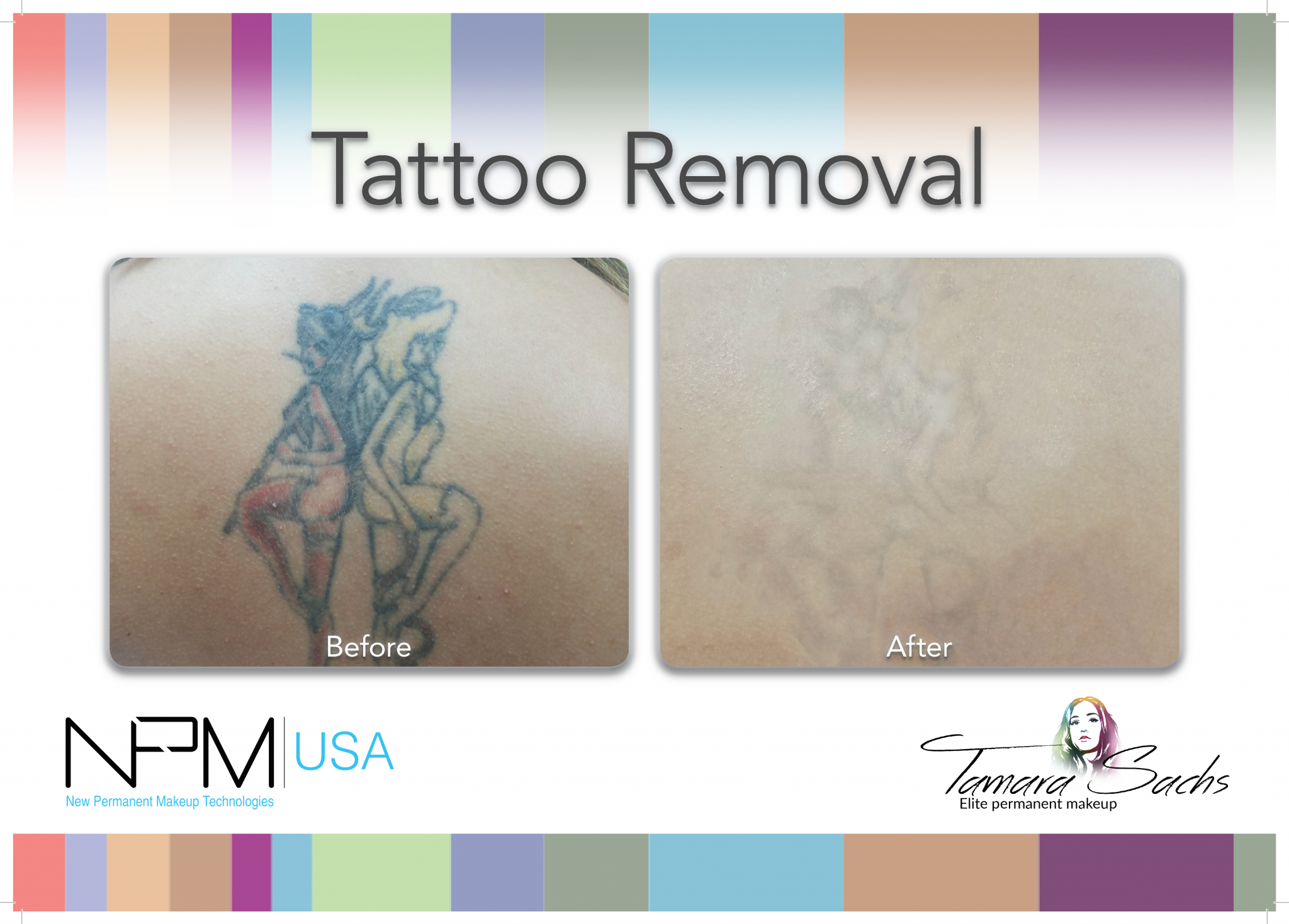 Laser Tattoo Removal Course  LASER SAFETY ONLINE